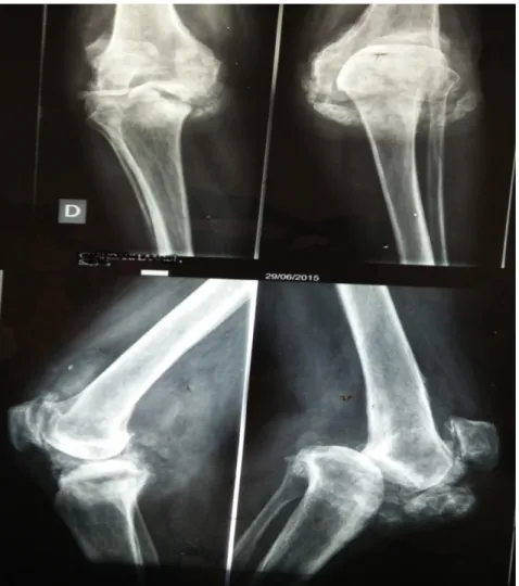 Figure 22 : radiographie face et profil montrant lésions lytiques et condensâtes avec luxation  postérieure du genou gauche