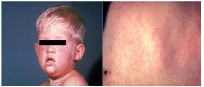 Figure 25 : Eruption morbiliforme(33)  2.  Evolution : 