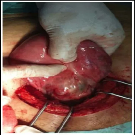 Figure 21 : Utérus en rupture incomplète, la grossesse ectopique sur la cicatrice de césarienne 