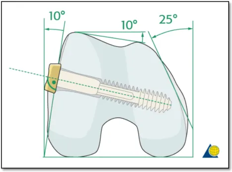 Figure 24 : Forme trapézoïde de la face inférieure de l’extrémité distale du fémur [14] 
