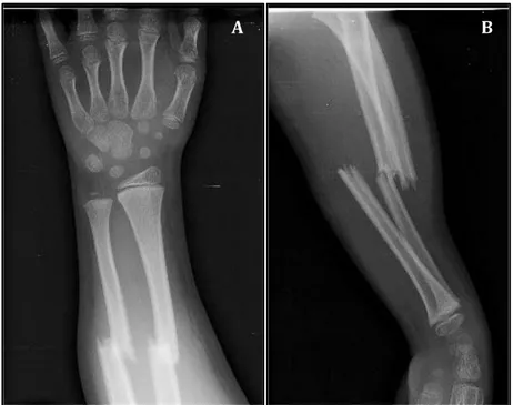 Figure 20  : Radiographie de face (A) et de  profil (B) objectivant une fracture déplacée des 2os  de l’avant-bras