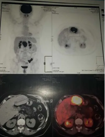 Figure 14  : Image sur TEP scan d’une MH au niveau du lobe gauche  