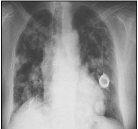 Figure 24 : Radiographie du thorax montrant une image en lâcher   de ballon chez un patient de notre étude