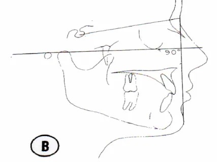 Figure 8 : Angle  facial  cutane  (Holdaway,  1983) 