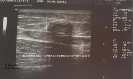 Figure 20 : Echographie-Doppler artériel montrant une thrombose du pontage fémoro-poplité 