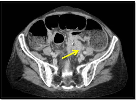 Figure 26: Epaississement  tumoral  sténosant la charnière recto sigmoïdienne rehaussé  par le contraste 