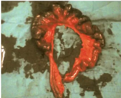 Figure 31 : Piéce de Resection ile-iléale avec nécrose étendue bridehernie volvulus jéjunaltumeur du grêletuberculose 