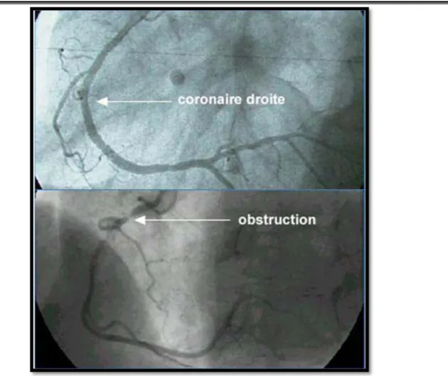 Figure 5 : Aspect coronarographique d’une lésion coronaire  ASPECTS THERAPEUTIQUES ET TRAITEMENT MEDICAL :  Une thrombolyse réussie a été réalisé chez 1  femme  VS 2 hommes   Echec de la thrombolyse chez  un homme (p=NS) 