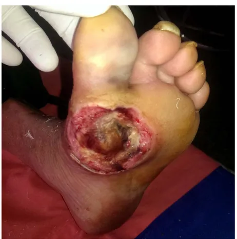 Figure 12 : Ulcère du pied avec exposition de l’os et issu de pus vu au service de Traumatologie- Traumatologie-orthopédie A 