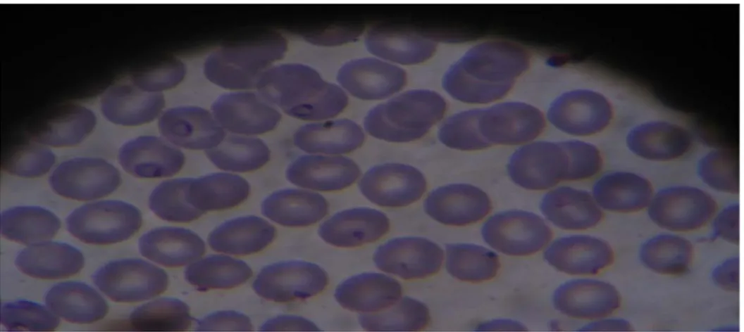 Figure 10 : Hématies parasitées sur frottis sanguin après coloration .  Tableau VII: La répartition des cas du paludisme selon l'espèce plasmodiale
