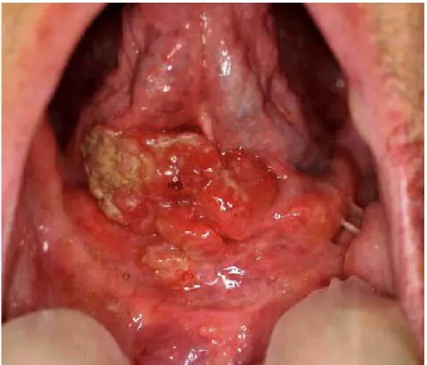 Figure 5 : Image montrant une lésion ulcéro bourgeonnante du plancher antérieur de la cavité  orale 