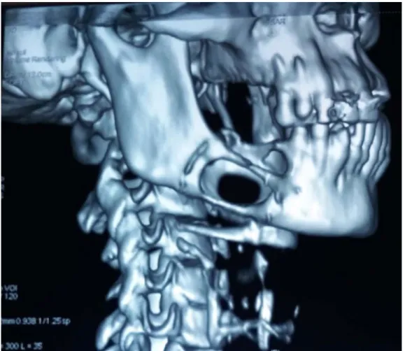 Figure 13 : Reconstruction 3D d’une tumeur ostéolytique de la branche horizontale de la  mandibule droite 