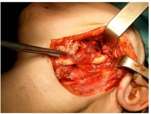 Figure 15 : Photo en per-opératoire montrant une résection interruptrice terminale 