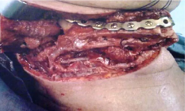 Figure 24 : Reconstruction mandibulaire après ostéotomie du péroné et fixé par une plaque