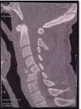 Figure 6 : Tomodensitométrie cervicale en coupe sagittale du rachis cervical montrant une  fracture luxation de C7