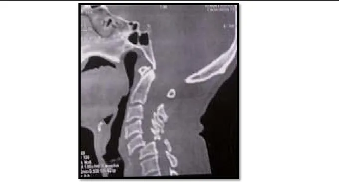 Figure 9 : Tomodensitométrie cervicale en coupe sagittale du rachis cervical montrant une  fracture luxation de C5-C6