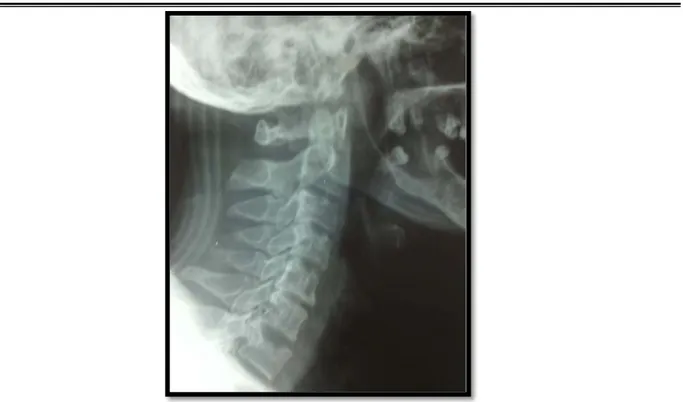 Figure 15 : Une radiographie standard de profil du rachis cervical montrant une fracture  tassement de C7