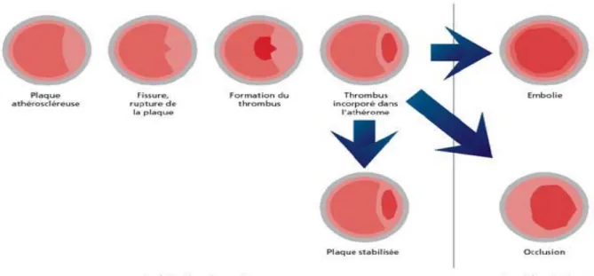 Figure 7 : Processus pathologique de l’athérothrombose. 
