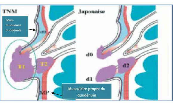 Figure 21 : Différence entre la classification TNM et la classification japonaise  (166)