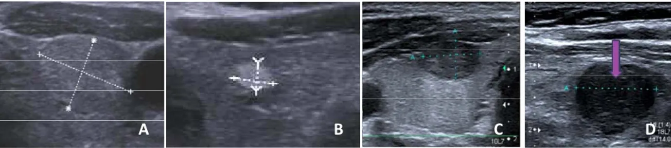 Figure 24 : Echogénécité tissulaire des nodules A. nodule isoéchogène, B : nodule  hyperéchogène, (52) C: nodule modérément hypoéchogène D: nodule fortement hypoéchogène.