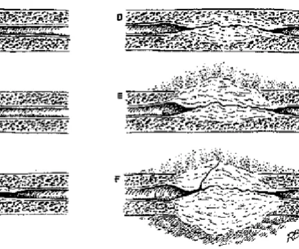 Figure 15 : La physiopathologie  des sténoses urétrales. 