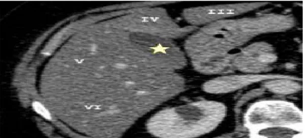 Figure N° 29 : Segmentation hépatique en scanner. Coupe axiale objectivant la vésicule  Biliaire