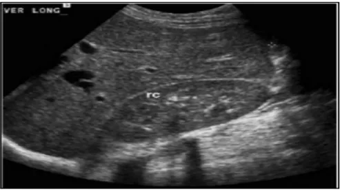 Figure N°33 : Aspect échographique normal du foie. L’échogénicité hépatique est égale ou  légèrement plus élevée que celle du cortex rénal (79) 