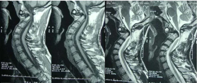 Figure 2 : IRM cervicale en coupes sagittales en séquences pondérées T1 et T2 montrant la  compression de la jonction bulbo-médullaire par la bascule postérieure du corps de C2 