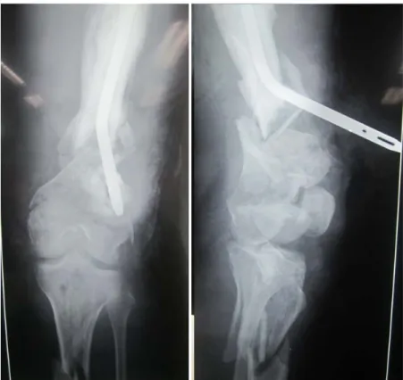 Figure : 11 Fracture de l’EIF sur clou associé à une fracture du tibia  
