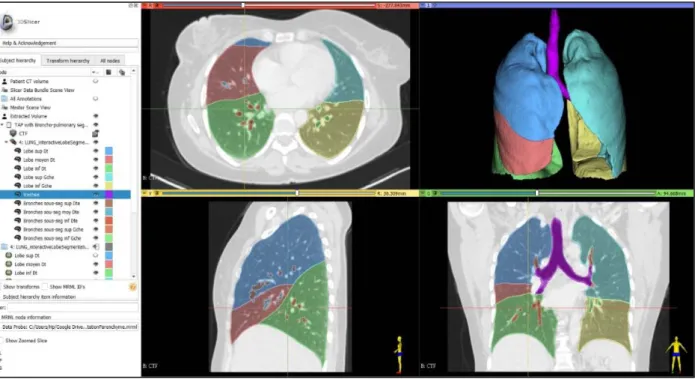 Figure 3: Segmentation broncho-pulmonaire semi-automatique sur Slicer 3D