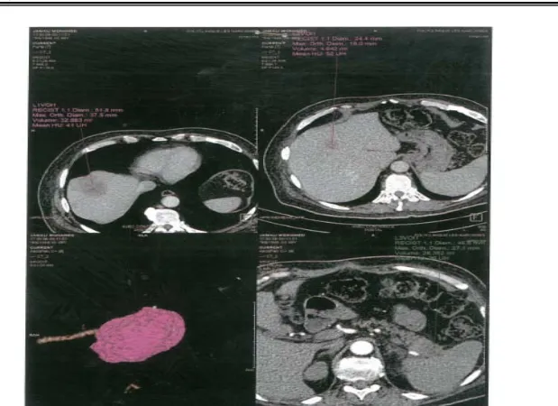 Figure  18: TDM abdominale montrant deux lésions hépatiques du segment IV et VIII sur une  Lesion tumorale de queue du pancréas (un cas de notre série)