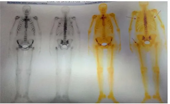 Figure 20 : Scintigraphie osseuse montrant de multiples foyers d’hyperfixation rachis  dorsolombaire, sternum, omoplate gh, gril costal, sacro-iliaques, cretes iliaques, extrémité 