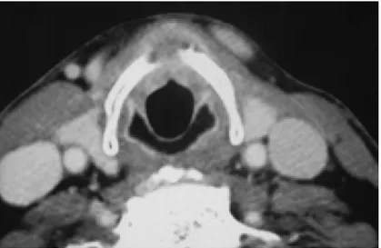 Figure 12 : Extension extra laryngée antérieure franchissant le cartilage thyroïde  2.2  Pan endoscopie : 