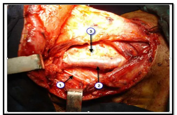 Figure 14 : Vue per opératoire de la région latéro-cervical au cours d’un   évidement  ganglionnaire.(Photo du  service ORL .CHU