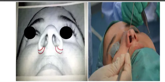 Figure 9: illustration  de résection narinaire  entre la simulation et la séance de « Live Surgery » 