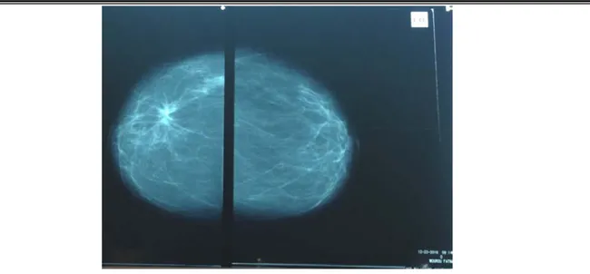 Figure 16.Mammographie : ndule du QSE du sein droit suspect de malignité ACR5 chez une   de nos patientes 