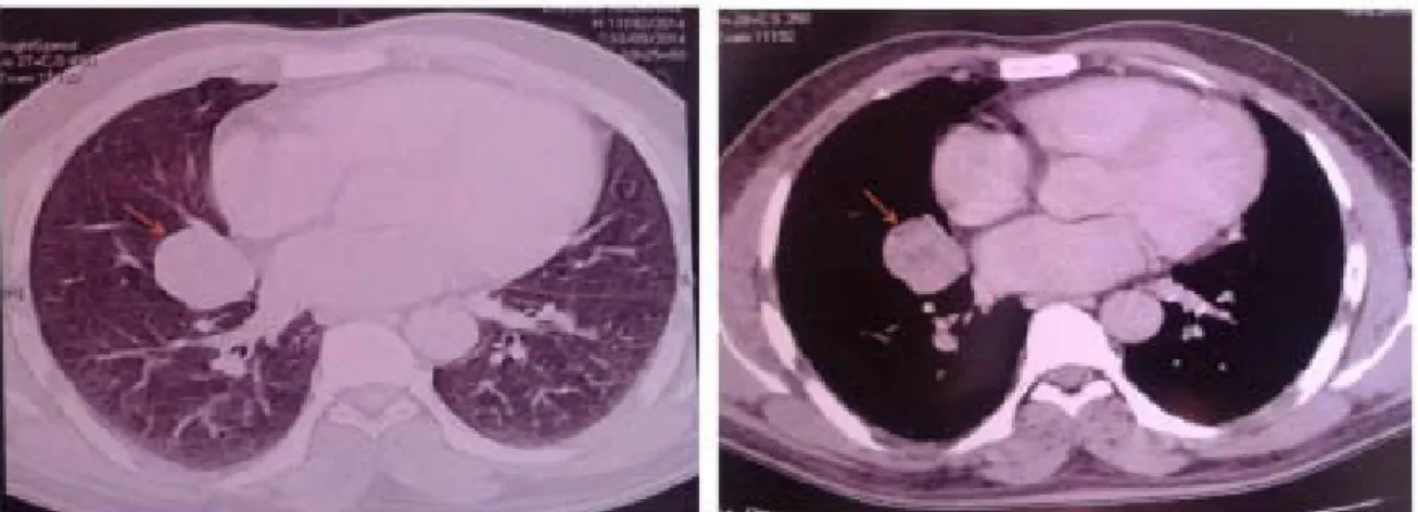 Figure 5 [1] : coupe axiale d’une TDM   thoracique objectivant une masse hétérogène prenant le  contraste avec quelques foyers nécrotiques bien délimitées mesurant (3 ,8 X 2,5 cm ) se 