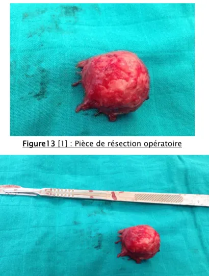 Figure 14 [1] :pièce de résection opératoire 
