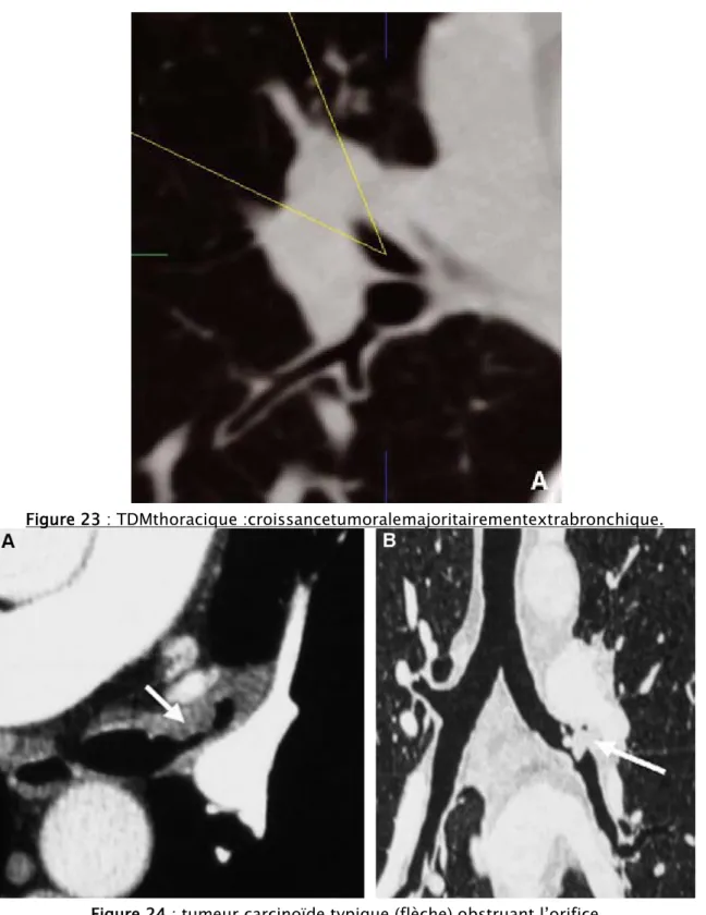 Figure 24 : tumeur carcinoïde typique (flèche) obstruant l’orifice   de la bronche lobaire supérieure gauche 