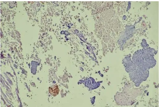 Figure 26 : Tumeur carcinoïde atypique avec foyer de nécrose tumorale (X20). 