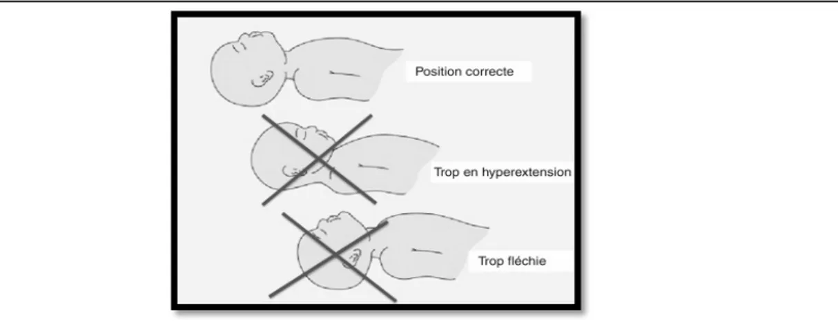 Figure 1: Positionnement correct du nouveau-né [1]. 