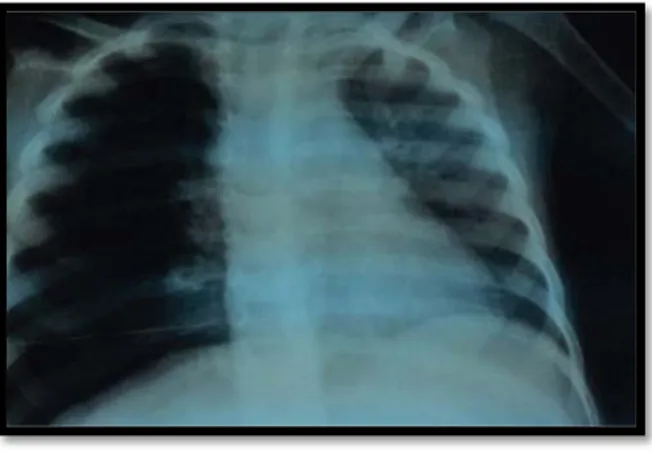 Figure 4: Radiographie thoracique de face montrant une hyper clarté de l’hémi champs droit  (Trapping), l’exploration endoscopique a permis l’extraction d’un sifflet au niveau de la bronche 