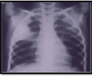 Figure 7: Pneumonie franche lobaire droit [5]. 