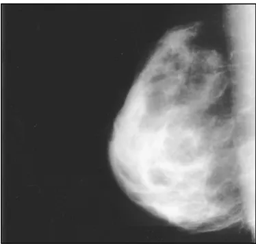 Figure 14: cliché mammographique d’une gynécomastie nodulaire diffuse : montre un sein  dense hétérogène très similaire à celui d'un sein féminin