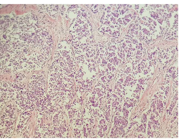 Figure 17 : prolifération carcinomateuse infiltrante organiséz en lobules en amas et en través  (HEX20) 82%6%5%4%3% CCI Sarcome phyllode Carcinome lobulaireNon préciséNOS
