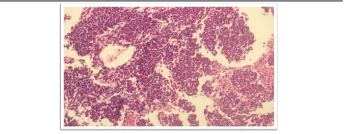 Figure 2 : Image à faible grossissement d’un médulloblastome classique.  L’importante densité cellulaire est, dès ce grandissement, frappante