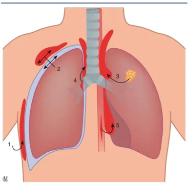 Figure 8 : ESC droit associé à une contusion pulmonaire du côté droit . 
