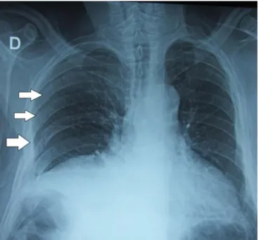 Figure 9: Radiographie thoracique de face : fracture de l’arc moyen  des 5éme, 6éme et7éme côtes droites