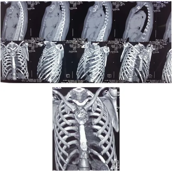 Figure 15 : Masse sternale rompant la cortical contenant des calcifications   en rapport avec un chondrosarcome 