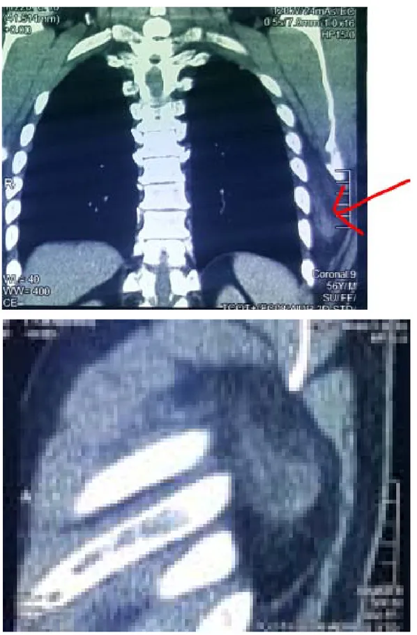 Figure 21 : Masse tissulaire fusiforme de la partie thoracique gauche    en rapport avec un élastofibrome 